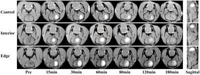 Mechanism of extracellular space changes in cryptococcal brain granuloma revealed by MRI tracer